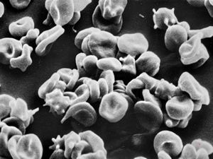 M,30y. | blood - dyserythropoetic anemia M,30y. | blood - dyserythropoetic anemia